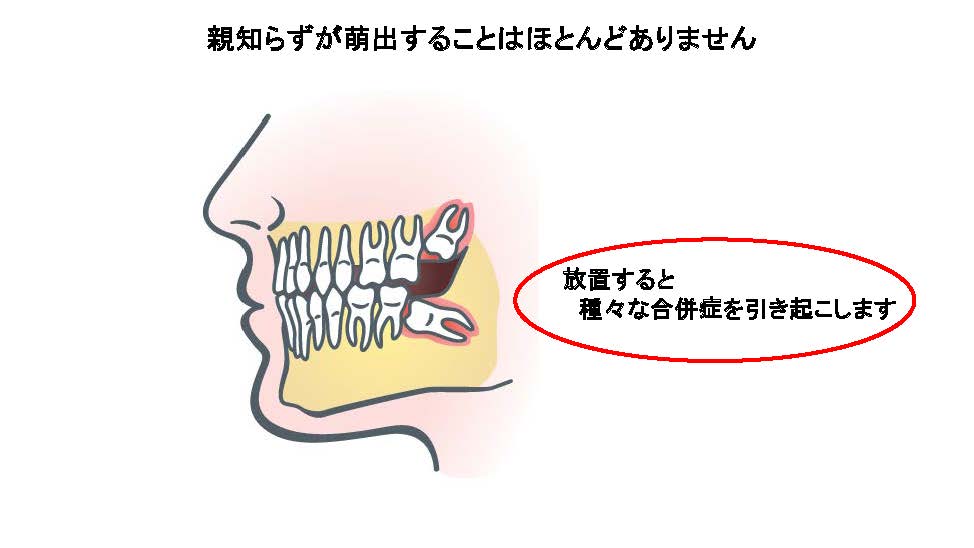 親知らず 小 顔