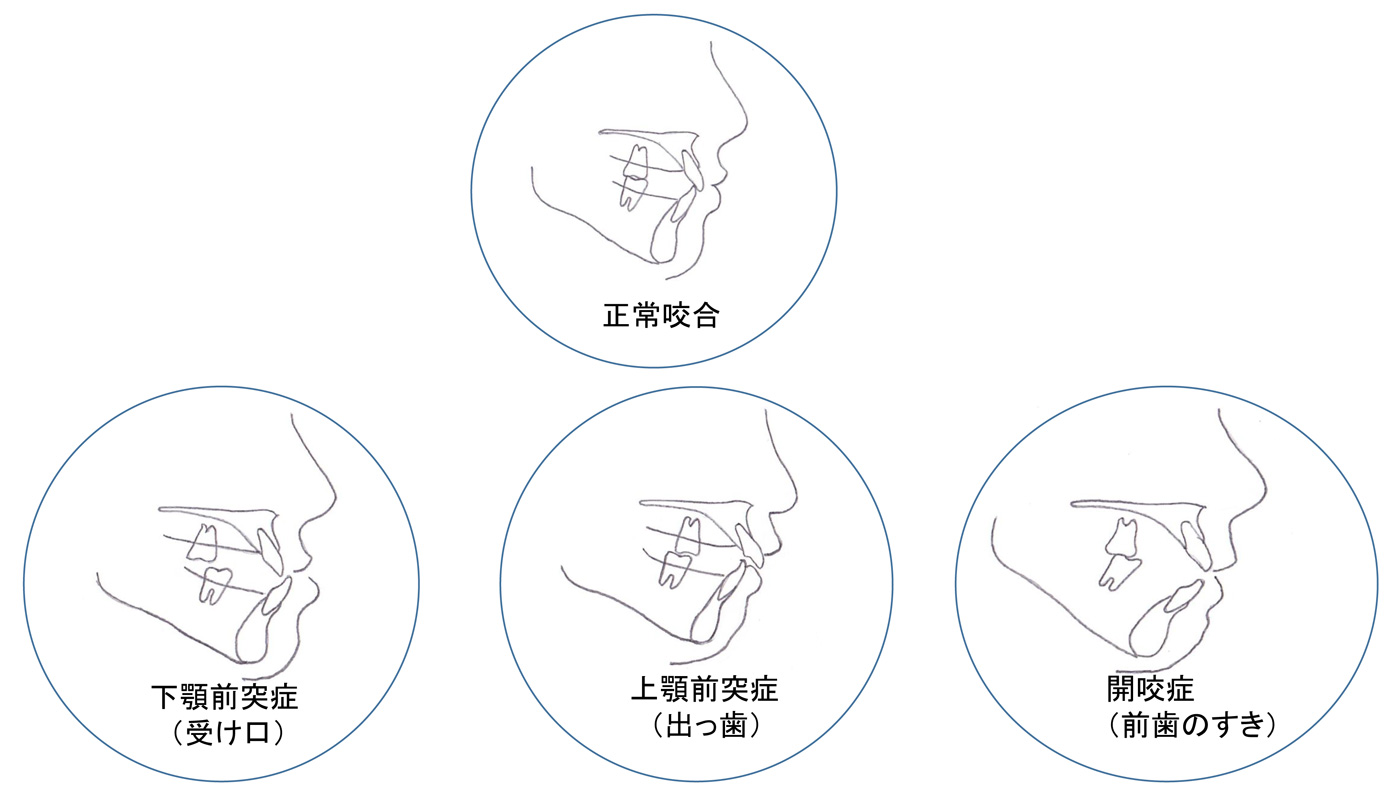 顎変形症 輪郭形成 所沢市の歯科口腔外科 武藤歯科口腔外科クリニック 顎変形症 輪郭形成 所沢市の歯科口腔外科 武藤歯科口腔外科クリニック