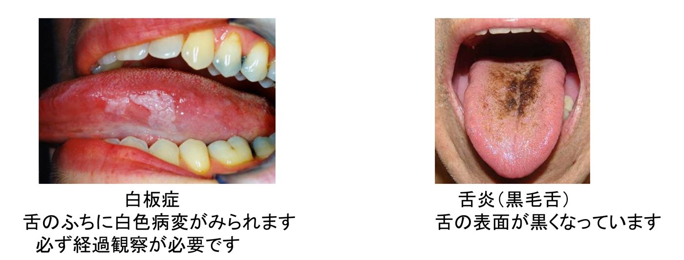 が 舌 でこぼこ ふち の 舌の病気や種類について解説!こんな症状がある場合は要注意