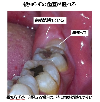 親知らず 小 顔