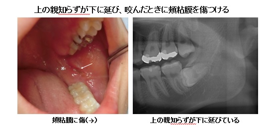 親知らず 頬 の 内側 痛い