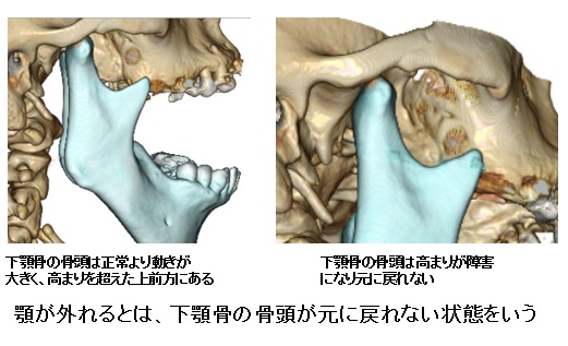 顎 外れる と どうなる